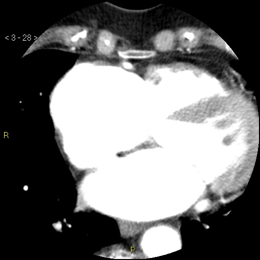 Aortoiliac occlusive disease (Radiopaedia 16828-16548 A 28).jpg