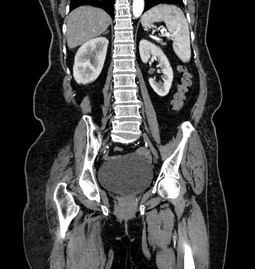 Aortoiliac occlusive disease (Radiopaedia 52352-58248 B 48).jpg