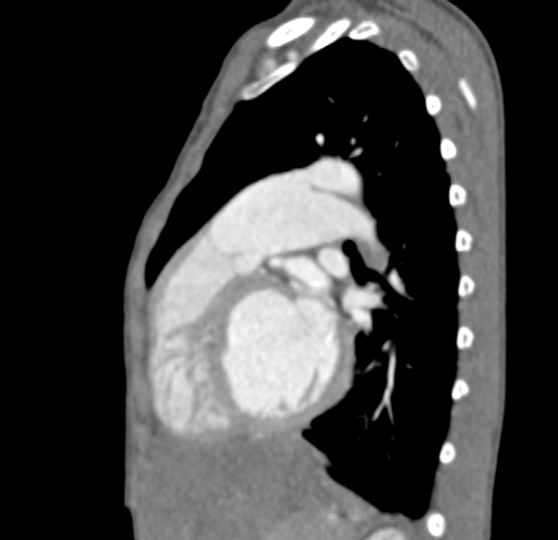 File:Aortopulmonary window, interrupted aortic arch and large PDA giving the descending aorta (Radiopaedia 35573-37074 C 31).jpg