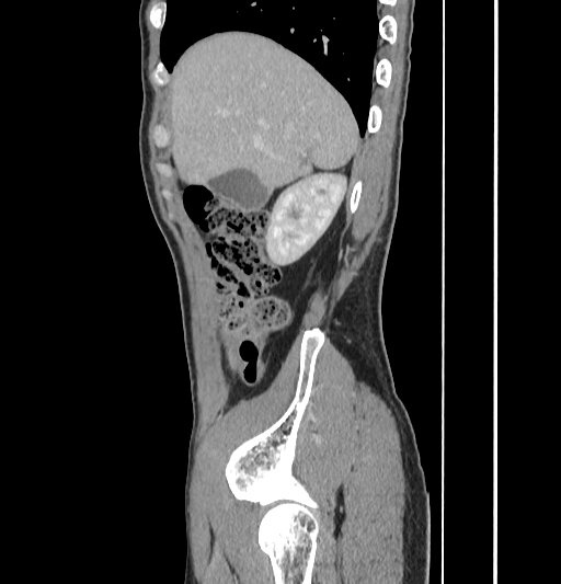 Appendiceal mucinous adenocarcinoma (Radiopaedia 66605-75922 C 12).jpg