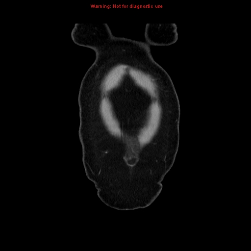 Appendiceal mucinous cystadenoma (Radiopaedia 8263-9111 B 3).jpg