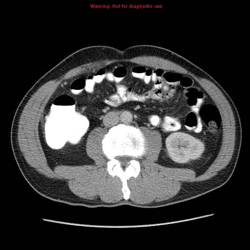File:Appendicitis and renal cell carcinoma (Radiopaedia 17063-16760 A 31).jpg