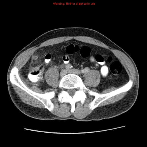 Appendicitis and renal cell carcinoma (Radiopaedia 17063-16760 A 39).jpg