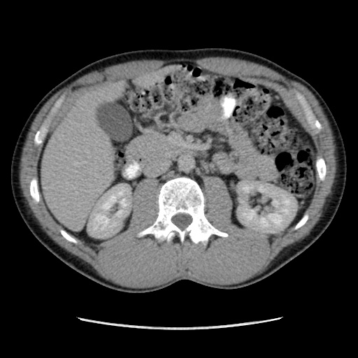 Appendicitis complicated by post-operative collection (Radiopaedia 35595-37113 A 28).jpg