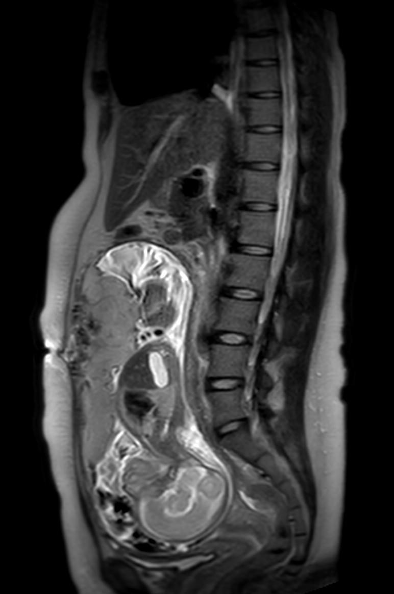 Appendicitis in gravida (MRI) (Radiopaedia 89433-106395 Sagittal T2 32).jpg