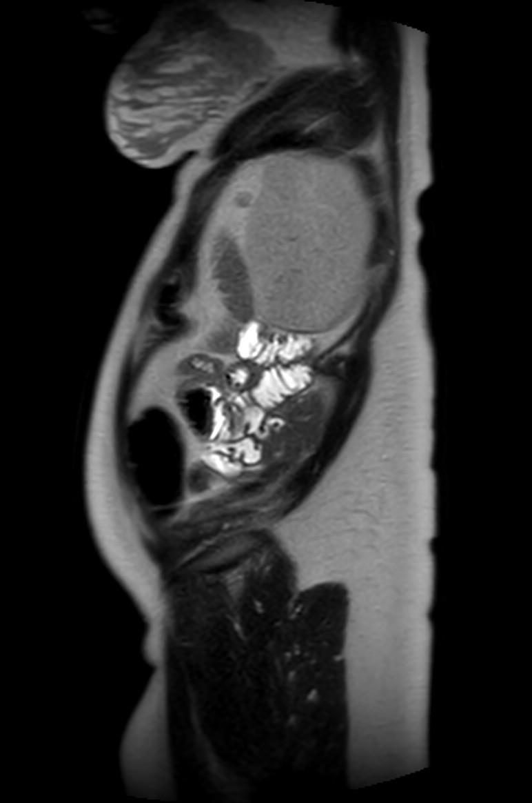 Appendicitis in gravida (MRI) (Radiopaedia 89433-106395 Sagittal T2 9).jpg