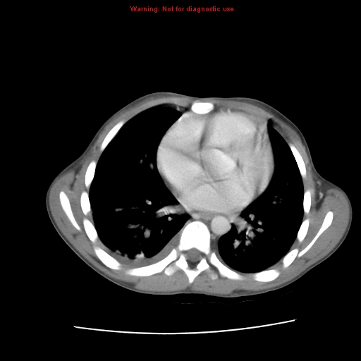 File:Appendicitis with phlegmon (Radiopaedia 9358-10046 A 4).jpg