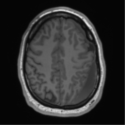 File:Arachnoid cyst with subdural hematoma (Radiopaedia 85892-101743 Axial T1 64).png