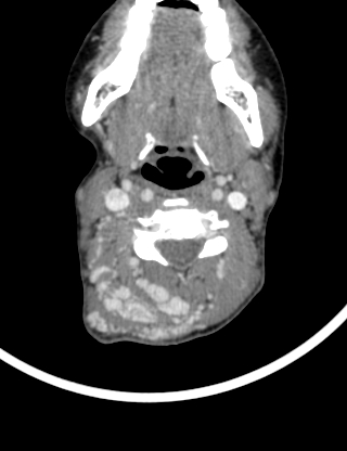 Arteriovenous malformation of the neck (Radiopaedia 53935-60062 B 21).jpg