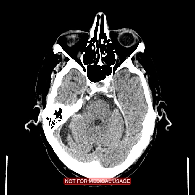 Artery of Percheron infarction (Radiopaedia 28679-28967 Axial non-contrast 35).jpg