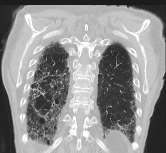 File:Asbestosis (Radiopaedia 56192-62864 Coronal lung window 43).png