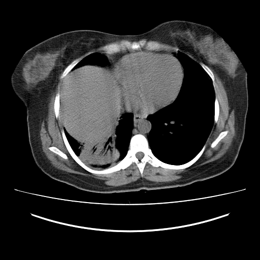 Ascending retrocecal appendicitis with liver abscesses (Radiopaedia 60066-67615 Axial non-contrast 4).jpg
