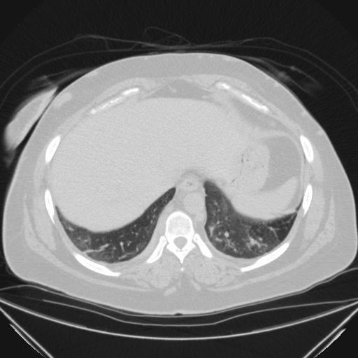 Aspergilloma (Radiopaedia 39611-41932 Axial lung window 114).jpg
