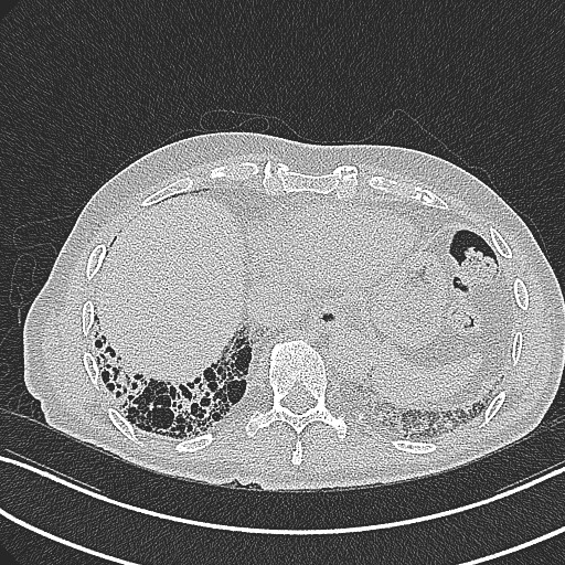 File:Aspergilloma on background pulmonary fibrosis (Radiopaedia 60942-68757 B 42).jpg