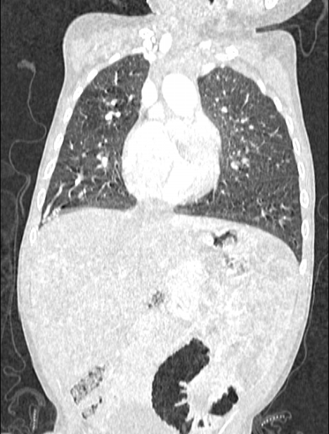 Asplenia syndrome (Radiopaedia 73083-83792 Coronal lung window 57).jpg