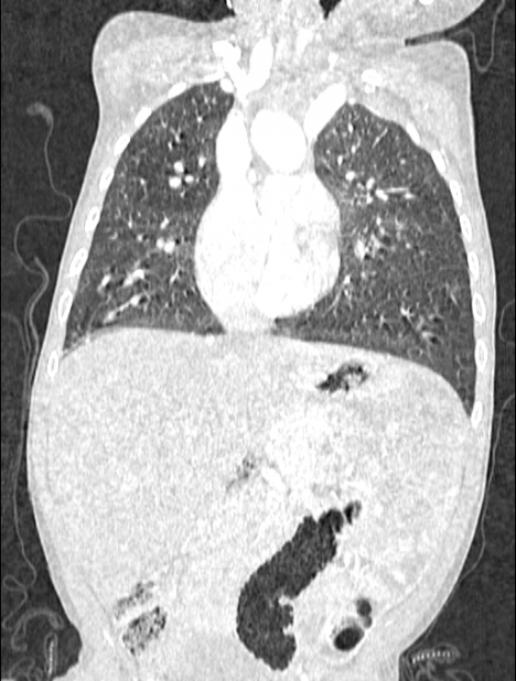 Asplenia syndrome (Radiopaedia 73083-83792 Coronal lung window 61).jpg