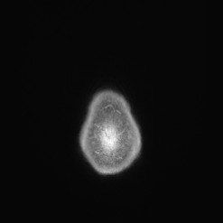 Astrocytoma (Radiopaedia 85660-101440 I 159).jpg