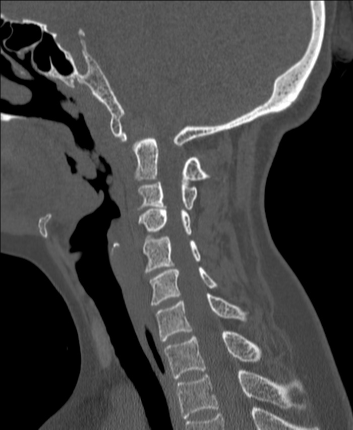 Atlanto-occipital assimilation with basilar invagination (Radiopaedia 70122-80188 Sagittal bone window 82).jpg