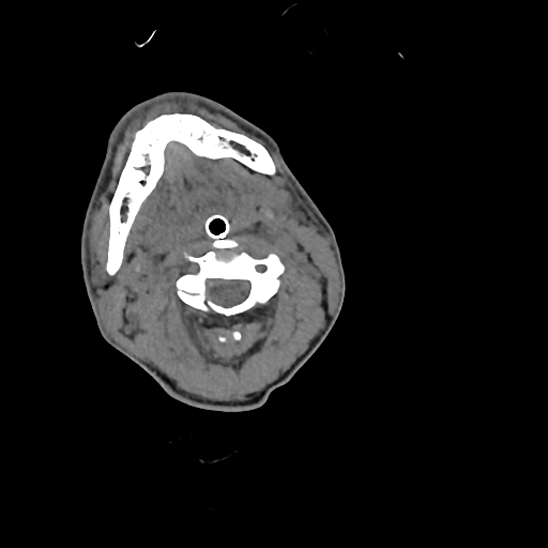 File:Atlanto-occipital dissociation (Traynelis type 1), C2 teardrop fracture, C6-7 facet joint dislocation (Radiopaedia 87655-104061 Axial non-contrast 31).jpg