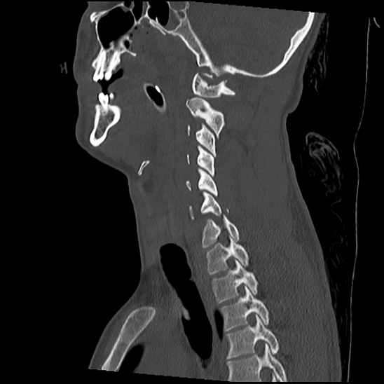 File:Atlanto-occipital dissociation (Traynelis type 1), C2 teardrop fracture, C6-7 facet joint dislocation (Radiopaedia 87655-104061 Sagittal bone window 30).jpg