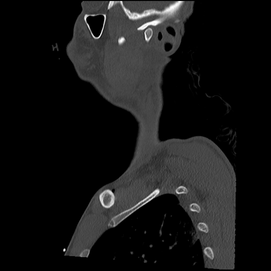 Atlanto-occipital dissociation (Traynelis type 1), C2 teardrop fracture, C6-7 facet joint dislocation (Radiopaedia 87655-104061 Sagittal bone window 4).jpg