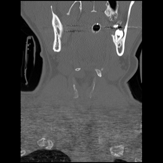 Atlanto-occipital dissociation injury (Radiopaedia 29274-29698 Coronal bone window 50).png