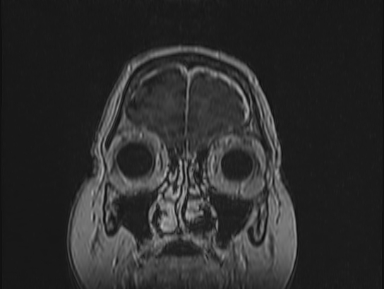Atypical meningioma (Radiopaedia 62985-71406 Coronal T1 C+ 10).jpg