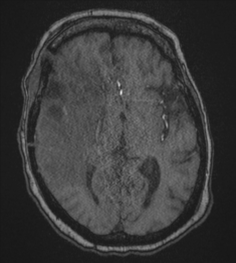 Atypical meningioma (WHO Grade II) (Radiopaedia 54742-60981 Axial MRA 50).png
