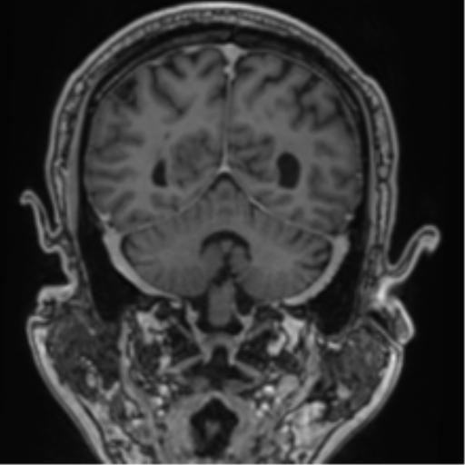 File:Atypical meningioma (WHO grade II) with brain invasion (Radiopaedia 57767-64729 Coronal T1 C+ 61).png