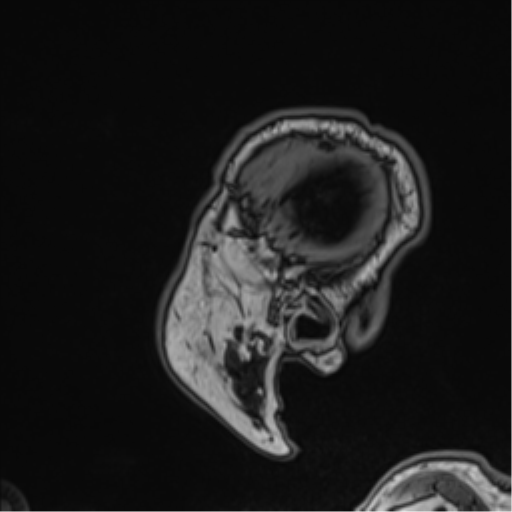 Atypical meningioma (WHO grade II) with brain invasion (Radiopaedia 57767-64729 Sagittal T1 61).png