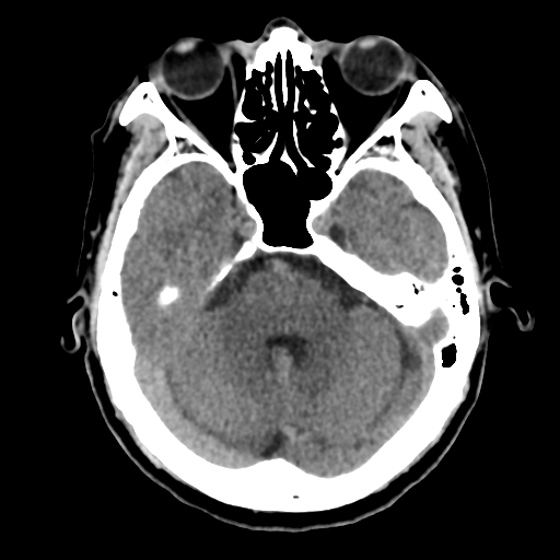 Atypical meningioma (WHO grade II) with osseous invasion (Radiopaedia 53654-59715 Axial non-contrast 17).png