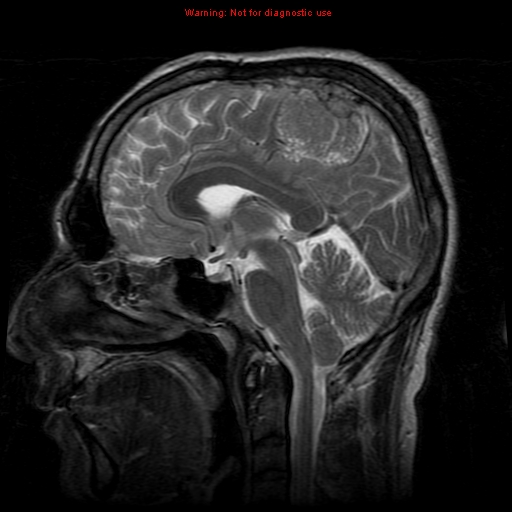 File:Atypical meningioma - grade II (Radiopaedia 13303-13305 Sagittal T2 12).jpg