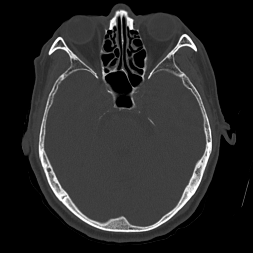 Atypical meningioma with skull invasion (Radiopaedia 34357-35649 Axial bone window 28).png