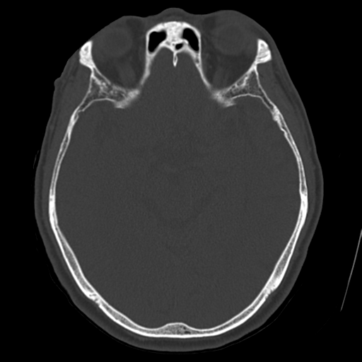 Atypical meningioma with skull invasion (Radiopaedia 34357-35649 Axial bone window 35).png