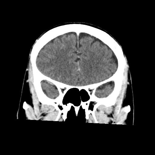 Atypical meningioma with skull invasion (Radiopaedia 34357-35649 Coronal C+ delayed 20).png