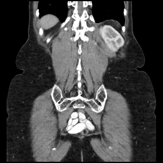 File:Atypical renal cyst (Radiopaedia 17536-17251 C 5).jpg