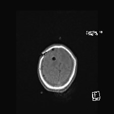 Atypical teratoid rhabdoid tumor (prenatal US and neonatal MRI) (Radiopaedia 59091-66388 Axial T1 50).jpg