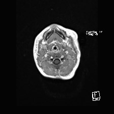 File:Atypical teratoid rhabdoid tumor (prenatal US and neonatal MRI) (Radiopaedia 59091-66388 Axial T1 C+ 2).jpg