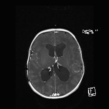 Atypical teratoid rhabdoid tumor (prenatal US and neonatal MRI) (Radiopaedia 59091-66388 Axial T1 C+ 36).jpg