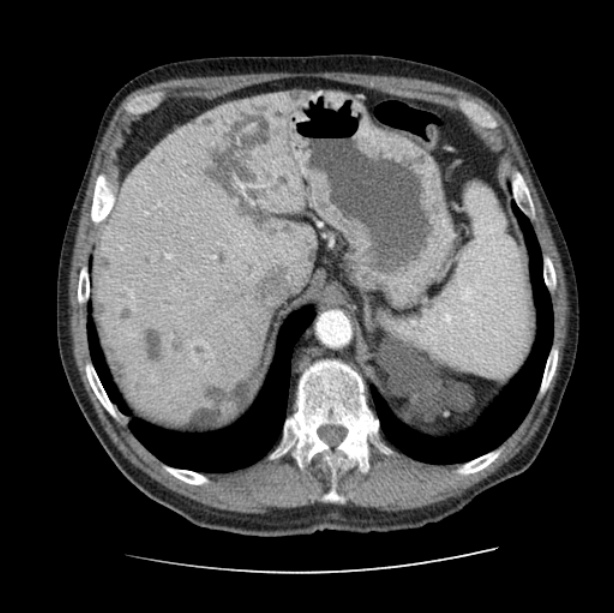 Autosomal dominant polycystic kidney disease (Radiopaedia 27851-28094 B 55).jpg