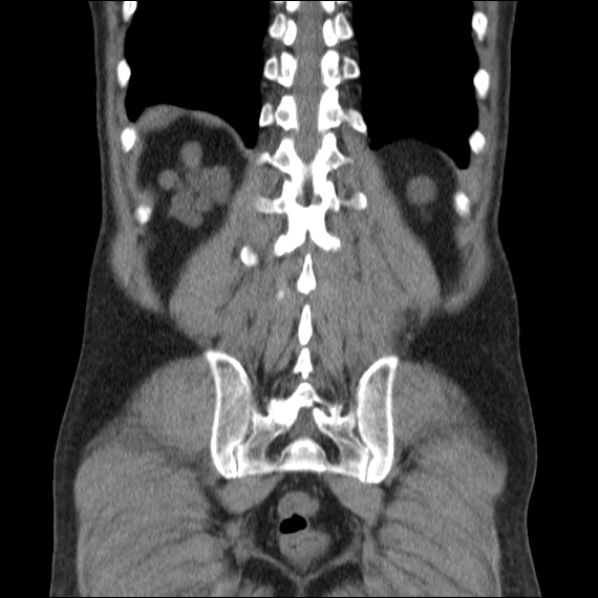 File:Autosomal dominant polycystic kidney disease (Radiopaedia 36539-38101 C 56).jpg