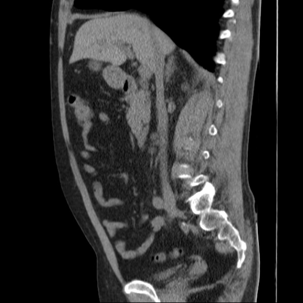 Autosomal dominant polycystic kidney disease (Radiopaedia 36539-38101 D 37).jpg