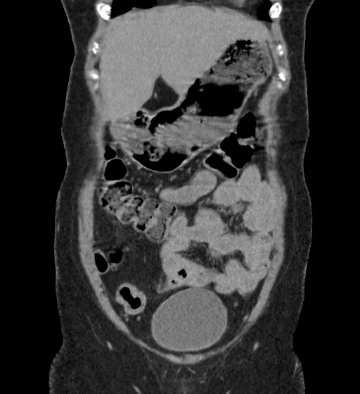 Autosomal dominant polycystic kidney disease (Radiopaedia 38189-40194 Coronal C+ delayed 8).jpg