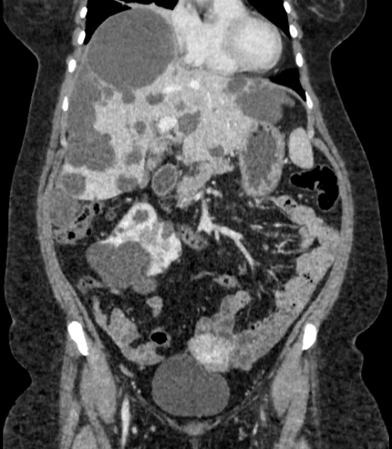 Autosomal dominant polycystic kidney disease (Radiopaedia 57124-64017 B 29).jpg