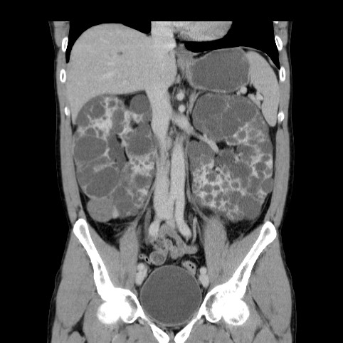 Autosomal dominant polycystic kidney disease (Radiopaedia 66349-75582 A 39).jpg