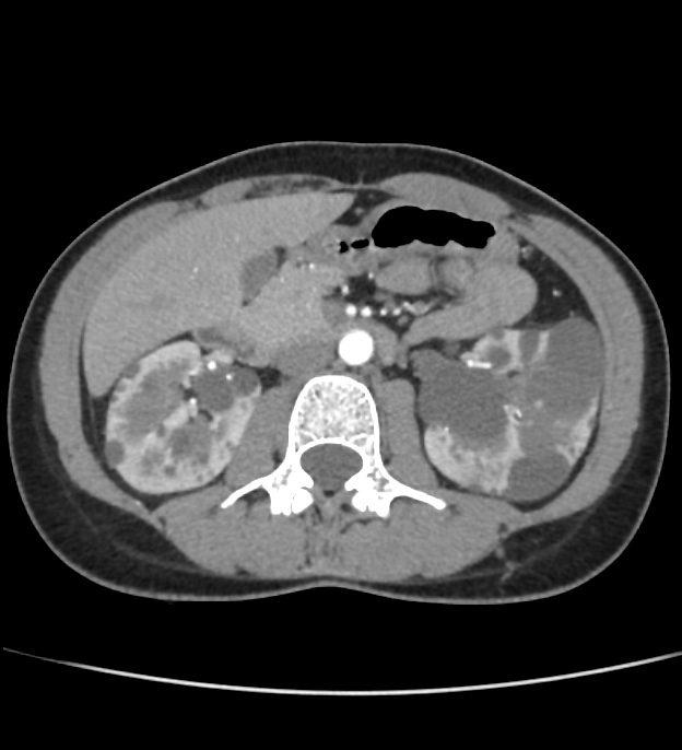 Autosomal dominant polycystic kidney disease - early onset (Radiopaedia 40734-43387 B 26).jpg