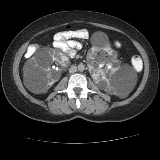 Autosomal dominant polycystic kidney disease with hepatic involvement (Radiopaedia 32693-33662 C 41).jpg