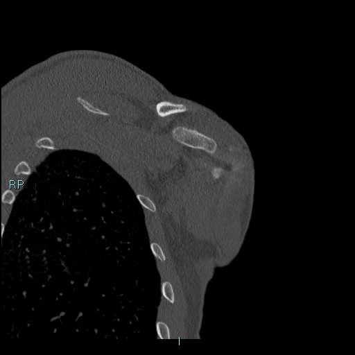 Avascular necrosis after fracture dislocations of the proximal humerus (Radiopaedia 88078-104655 Coronal bone window 108).jpg