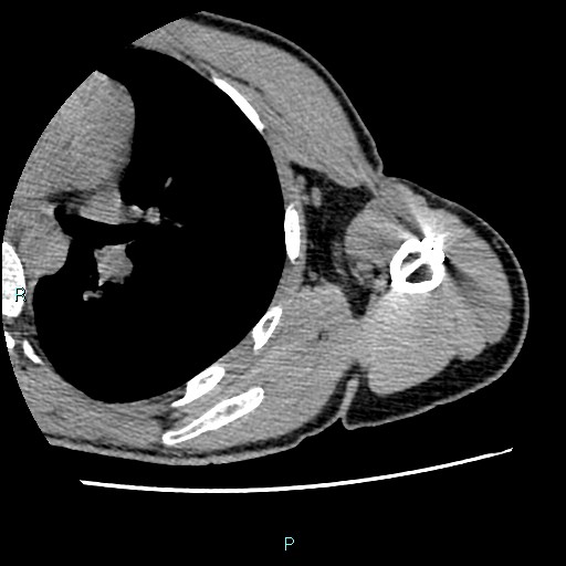 File:Avascular necrosis after fracture dislocations of the proximal humerus (Radiopaedia 88078-104655 D 85).jpg