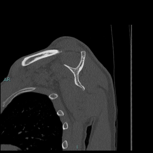 Avascular necrosis after fracture dislocations of the proximal humerus (Radiopaedia 88078-104655 Sagittal bone window 42).jpg